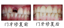 郑州唯美前种植牙成功案例