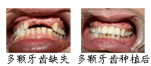 郑州唯美多颗牙齿缺失后治疗前后对比