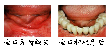 郑州唯美全口牙缺失治疗案例