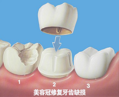 美容冠修复牙齿缺损要多少钱