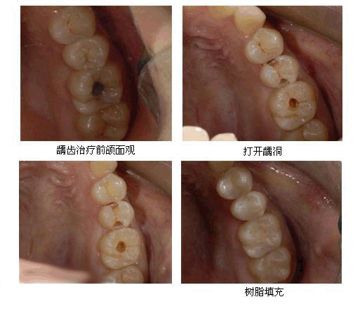 龋齿治疗