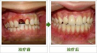 镶牙不成功应怎么办