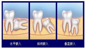 郑州无痛微创拔牙多少钱