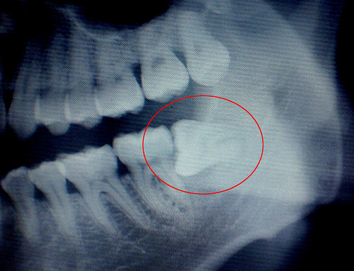 拔颗智齿需要多少钱