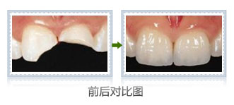 树脂补牙多少钱一颗