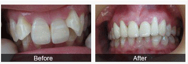 牙齿矫正后反弹的原因是什么
