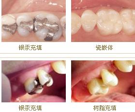 补牙的各种材料的优缺点