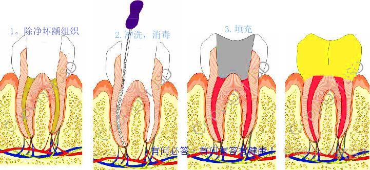 牙齿根管治疗多少钱