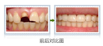 补蛀牙用哪种材料会比较好