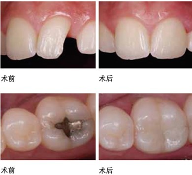 补一颗牙齿大概要多久