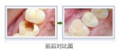 大牙有窟窿能补吗