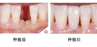 牙床萎缩能种牙吗