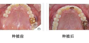 做了种植牙以后要注意些什么?