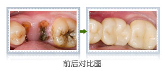 虫吃牙牙疼怎么办,